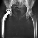 Answer HIP REPLACEMENT